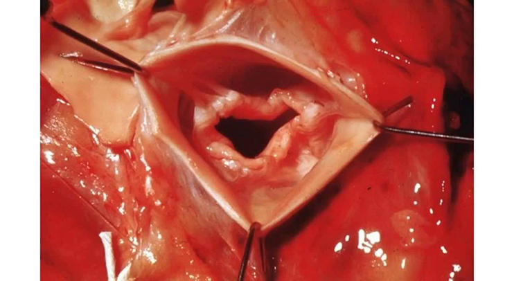 Предикторы ранних цереброваскулярных событий у пациентов с аортальным стенозом, перенесших транскатетерное протезирование аортального клапана
