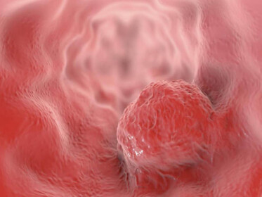 ASCO 2019: снижение дозоинтенсивности лечения у пожилых и ослабленных больных раком пищеводно-желудочного перехода эффективнее стандарта (результаты исследования GO2)