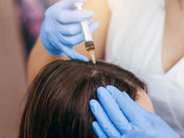Нова методика може лікувати втрату волосся, спричинену гніздовою алопецією