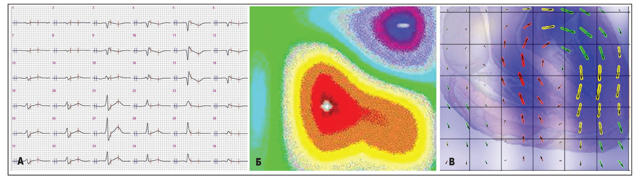 Рис. 2. Різні способи відображення магнітної активності серця: усереднені МКГ-криві (А), карта магнітного поля (Б) та розподілу ВГС (В)