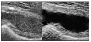 Рис. 3. УЗ-картина гемартрозу (зліва) порівняно з ексудативним транзиторним синовітом (справа) кульшового суглоба (особистий архів) 