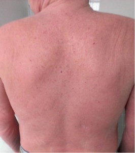 Рис. 1. Пациент О. Диагноз: «Т-клеточная лимфома кожи» (здесь и далее – фото предоставлены автором)