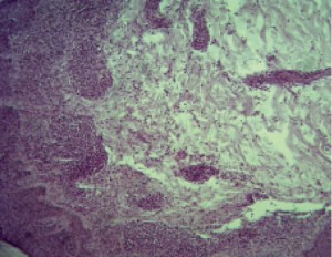 Рис. 2. Пациент О. Диагноз: «Т-клеточная лимфома» (микропрепарат), окраска гематоксилином и эозином