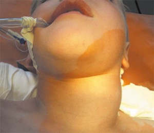 Рисунок 2. Лимфогранулематоз (пакет лимфоузлов на шее слева). Ребенок подготовлен к биопсии лимфоузлов шеи