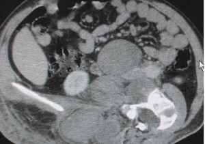 Рисунок 4. Компьютерная томограмма увеличенных внутрибрюшных и забрюшинных лимфоузлов при лимфоме