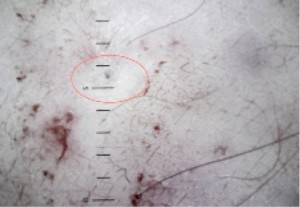 Рис. 2. Пациентка П. Дерматоскопия: в очаге наличие темной точки в центре инфильтрата (обведено красным)