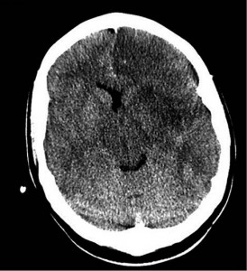 Рис. 1. Большой участок ишемии в левом полушарии головного мозга (компьютерная томография)