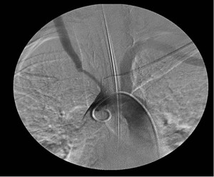 Рис. 2. Окклюзия правой подключичной и левой общей сонной артерии, стеноз брахиоцефального ствола (ангиография)
