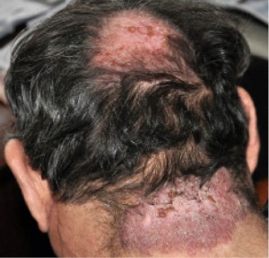 Рис. 2. Язвенно-атрофическая форма саркоидоза кожи  в области волосистой части головы, затылка, шеи 
