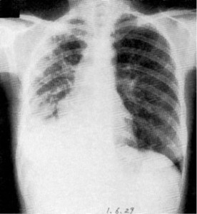 Рис. 5. Рентгенограма органів грудної клітки (ОГК) в прямій проекції, що демонструє ознаки правобічної пневмонії у пацієнта з первинним дефіцитом IgG2, IgG4 та IgЕ (за Ninomiya H. зі співавт.)