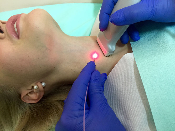 Лазерная абляция эффективна и безопасна в качестве  метода лечения доброкачественных узлов  щитовидной железы