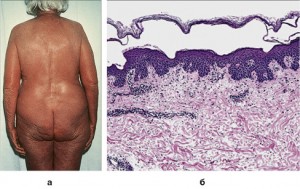 Рис. 1. Псориатическая эритродермия
