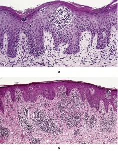 Рис. 4. Синдром Сезари, микропрепарат (окраска гематоксилин- эозин): а – микроабсцессы Потрие; б – в эпидермисе: гиперкератоз, выраженный акантоз, густой инфильтрат в верхней части дермы, состоящий из атипичных лимфоцитов
