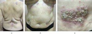 Рис. 1. Пациентка Н. IgA-зависимый линеарный буллезный дерматоз, до лечения (фото предоставлено авторами)