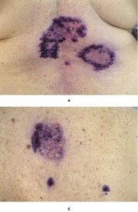Рис. 2. Пациентка Н. IgA-зависимый линеарный буллезный дерматоз, после лечения (фото предоставлено авторами)