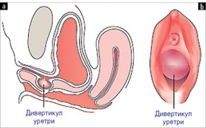 Рис. 12. Дивертикул уретри на сагітальному розрізі (а) та при вагінальному огляді (b) [19]