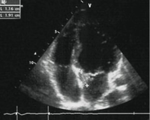 Рисунок 27. Сканограма серця пацієнтки В., 14 років. Вегетація на мітральному клапані (вказано стрілкою)