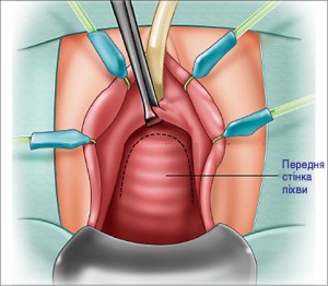 Рис. 25. Етапи дивертикулектомії: розсічення передньої стінки піхви у вигляді перевернутої букви U [28]