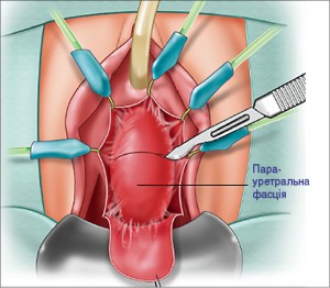 Рис. 26. Етапи дивертикулектомії: виділення ДУ та розсічення парауретральної фасції у поперечному напрямку [28]