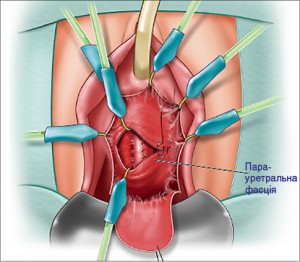 Рис. 31. Етапи дивертикулектомії: зашивання парауретральної фасції у поперечному напрямку вікриловими швами (4-0) [28]