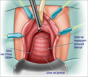 Рис. 32. Етапи дивертикулектомії: зашивання передньої стінки піхви [28]