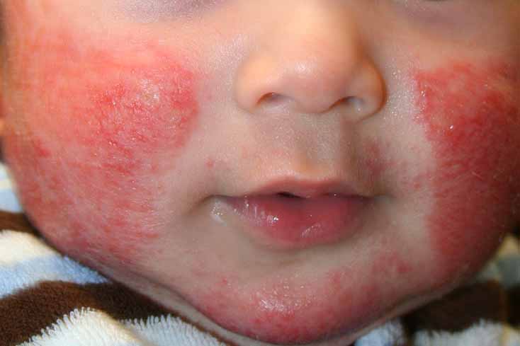 Реферат: Атопический дерматит у детей