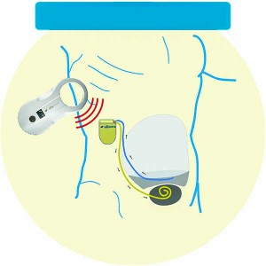 Рис. 2. Имплантируемое устройство для лечения рефрактерного асцита