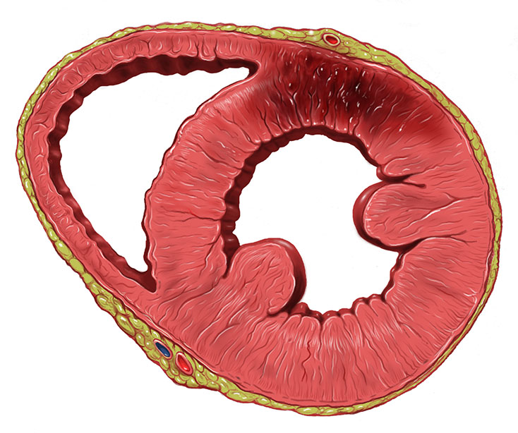 Фрагментированный комплекс QRS и его влияние на краткосрочные исходы у пациентов с острым инфарктом миокарда без подъема сегмента ST