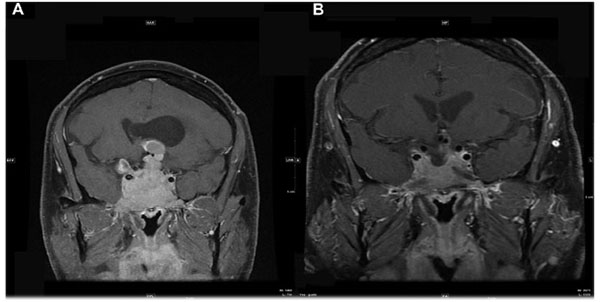 Рис. 1. МРТ гипофиза до (А) и после (Б) 6 месяцев терапии каберголином
