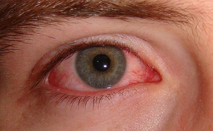 В США появится рецептурный препарат для лечения синдрома сухого глаза