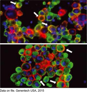 Рис. 3. Экспрессия PD-L1, выявленная иммунофлюоресцентным методом на клетках рака легкого (красный цвет). Стрелками показаны инфильтрирующие опухоль макрофаги  (зеленые: CD163 на верхнем снимке, CD68 на нижнем), которые экспрессируют PD-L1.  Ядра клеток обозначены синим