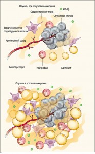 Рис. 1. Жировые клетки изменяют микроокружение опухоли. При ожирении наблюдается увеличение количества звездчатых клеток, нейтрофилов и IL-1β, а также адипоцитов. Из-за перекрестных сигнальных воздействий между адипоцитами, нейтрофилами, звездчатыми клетками и другими компонентами микроокружения увеличивается количество воспалительных клеток, происходит избыточное образование фиброзной соединительной ткани в непосредственной близости от опухоли. Более плотное микроокружение опухоли, которое отмечается при ожирении, создает дополнительное механическое напряжение тканей, может препятствовать нормальной перфузии и уменьшать ответ на ХТ