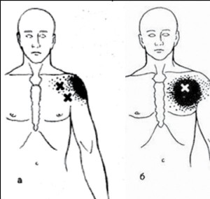 Рис. 4. Болевой паттерн при локализации ТТ в левой большой грудной мышце: а— ключичная часть; б— грудинная часть (по Дж. Тревелл, Д. Симонс, 1989)