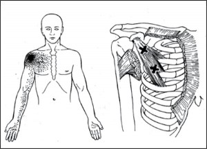 Рис. 5. Болевой паттерн при локализации ТТ в малой грудной мышце (по Дж. Тревелл, Д. Симонс, 1989)