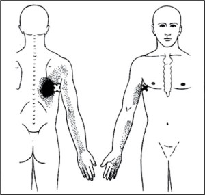 Рис. 7. Болевой паттерн при локализации ТТ в широчайшей мышце спины (по Дж. Тревелл, Д. Симонс, 1989)
