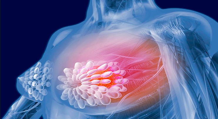 Рак молочної залози: фундаментальні та клінічні засади персоналізованого дизайну діагностики і лікування