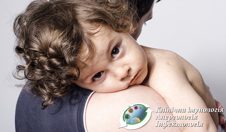 Харчова гіперчутливість у дітей: сучасні стандарти діагностики