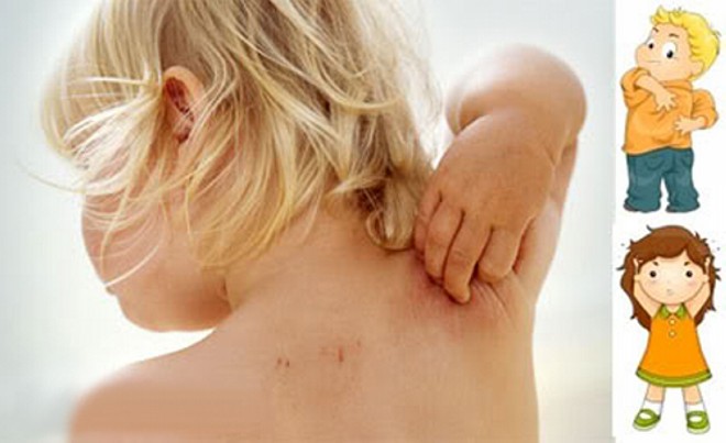 Частота сенсибілізації до харчових алергенів за даними шкірного прик-тестування у дітей із симптомами харчової гіперчутливості на шкірі