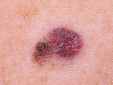 Меланома кожи: медикаментозное лечение в адъювантном режиме
