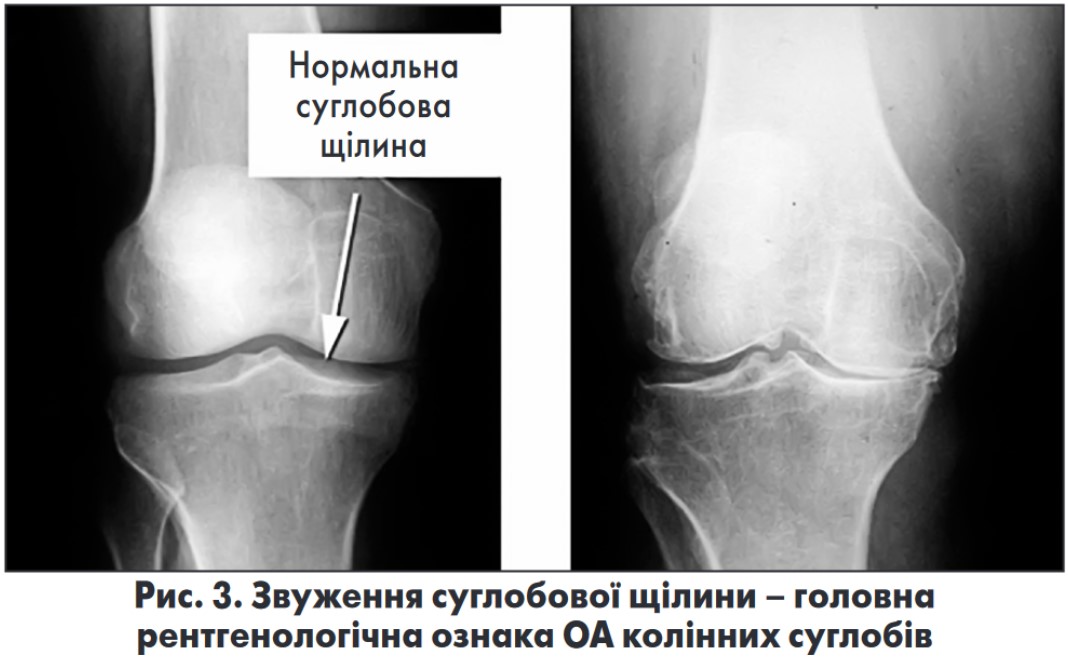 Повреждение коленного сустава 3 степени