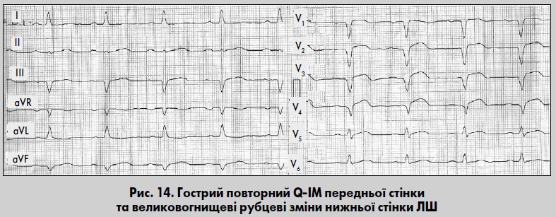 Електрокардіографічна діагностика  інфаркту міокарда: звертаємося до підручника