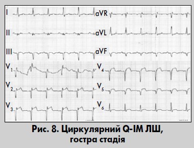 Електрокардіографічна діагностика  інфаркту міокарда: звертаємося до підручника
