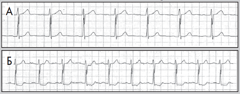 Рис. 12. Фрагменти ХМ ЕКГ у пацієнта,  який раніше переніс інфаркт міокарда:  А – ​немає змін сегмента ST,  Б – ​безсимптомна депресія сегмента ST