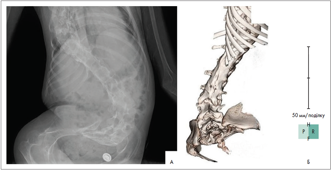 Рис. 1. А – передньозадній рентгенівський знімок хребців у одній проєкції; Б – тривимірний реконструйований КТ-знімок