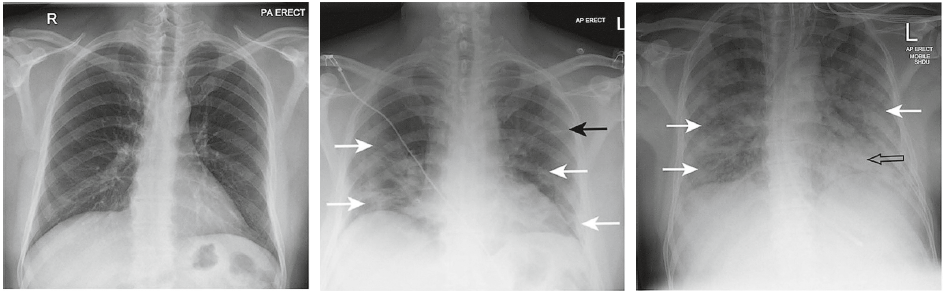 Рис. 3. Серія рентгенограм ОГК, що відображають прогресування COVID‑19