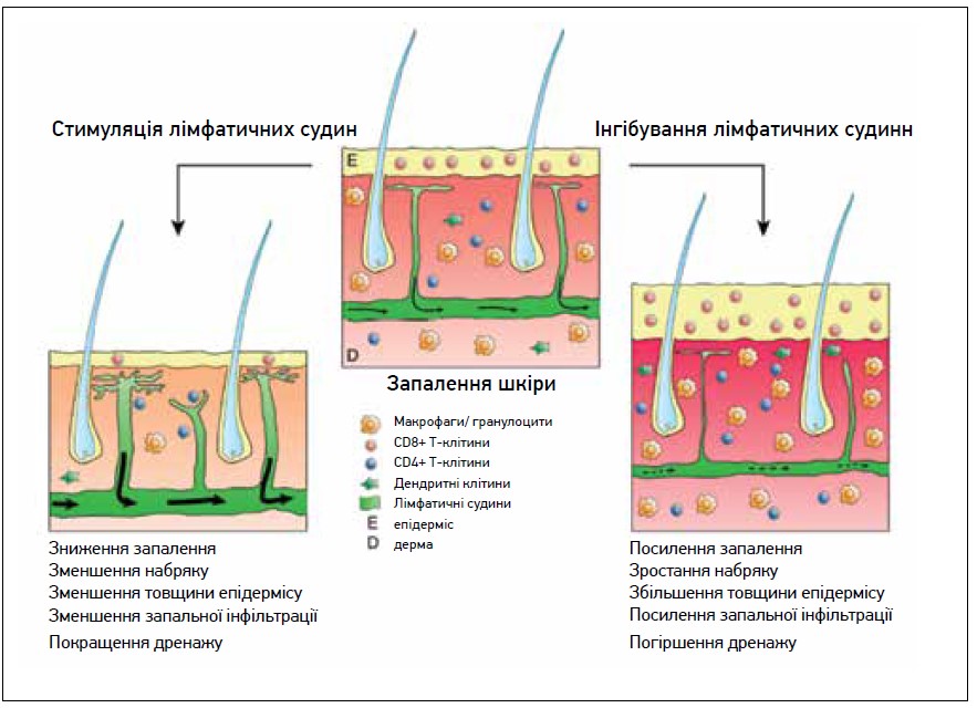 Рис. Вплив стимуляції та інгібування лімфатичних судин на активність запалення шкіри (за Schwager S. et al., 2019 [15])