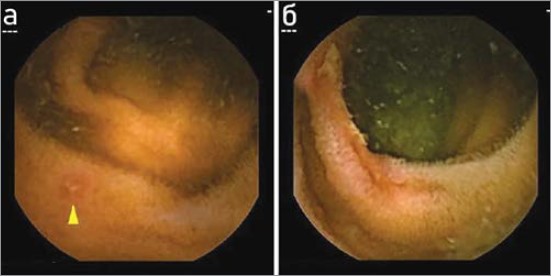 Рис. 1. Капсульна ендоскопія – візуалізація пошкоджень слизової оболонки тонкої кишки в пацієнтів, які приймають низькі дози АСК