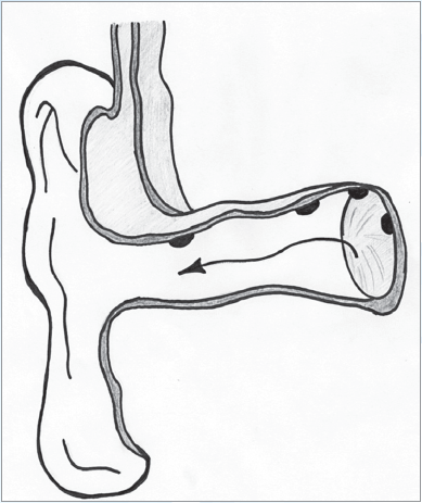 Рис. 1. Шлях міграції епідермісу та сірки назовні із зовнішнього слухового ходу