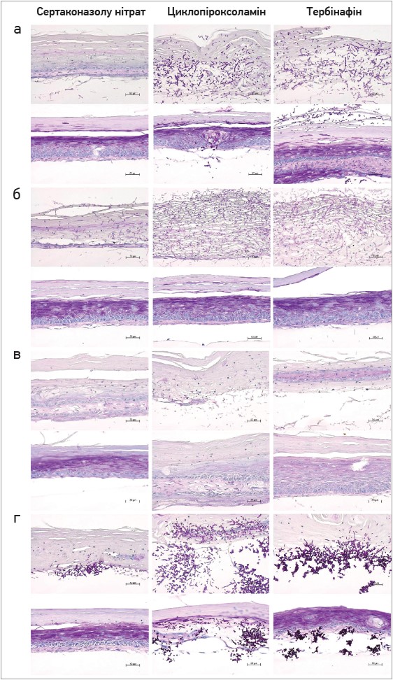 Рис. Гістологічні результати після зараження повних моделей шкіри T. rubrum (а), E. floccosum (б),  S. brevicaulis (в), C. Albicans (г) і лікування сертаконазолу нітратом, циклопіроксоламіном  або тербінафіном після 72 год (фарбування реактивом Шиффа, 200-кратне збільшення)
