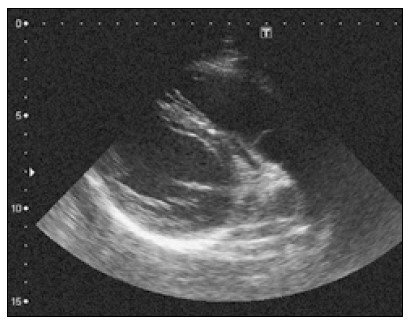 Рис. 2. Зображення вихідного шляху правого шлуночка з парастернального підходу